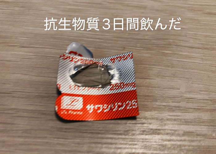 歯の治療で抗生物質（抗菌薬）を3日間服用