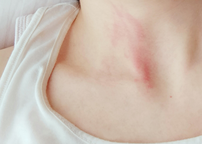 皮膚の症状 かゆみや発疹